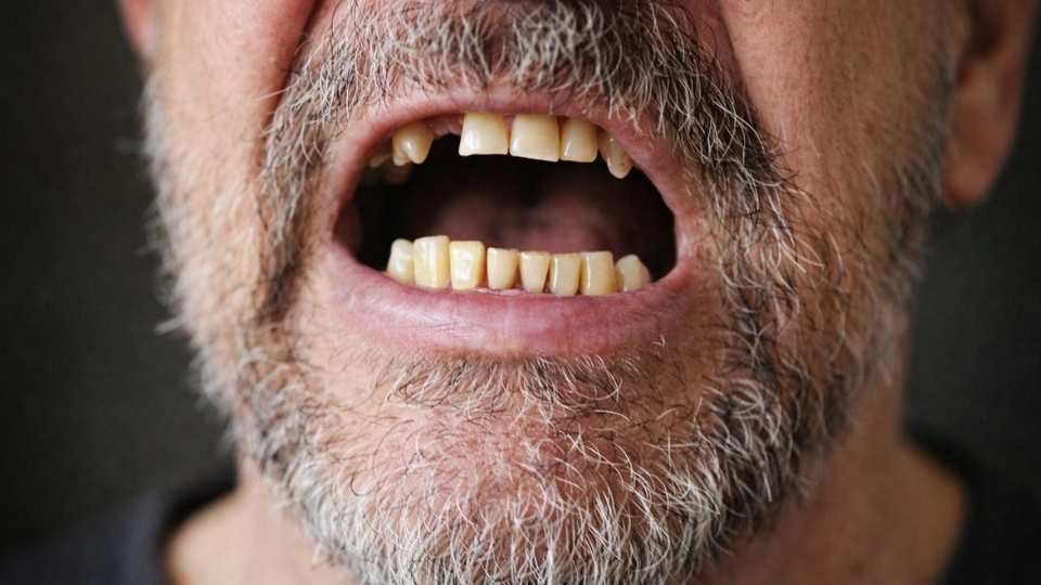 crystal meth images show a man missing teeth due to a phenomenon known as meth mouth