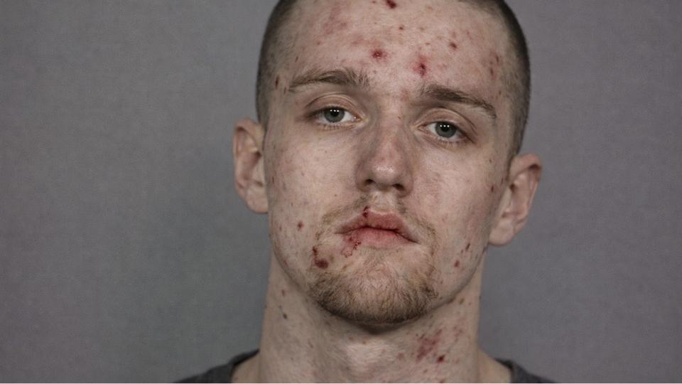 crystal meth images show what meth use might do to your face and body.