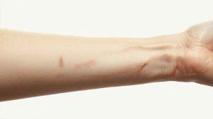 Track Marks & Skin Signs of Injection Drug Use hero image of a woman's arm.